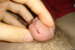 opening of penis hole