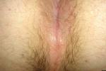 anus opening
